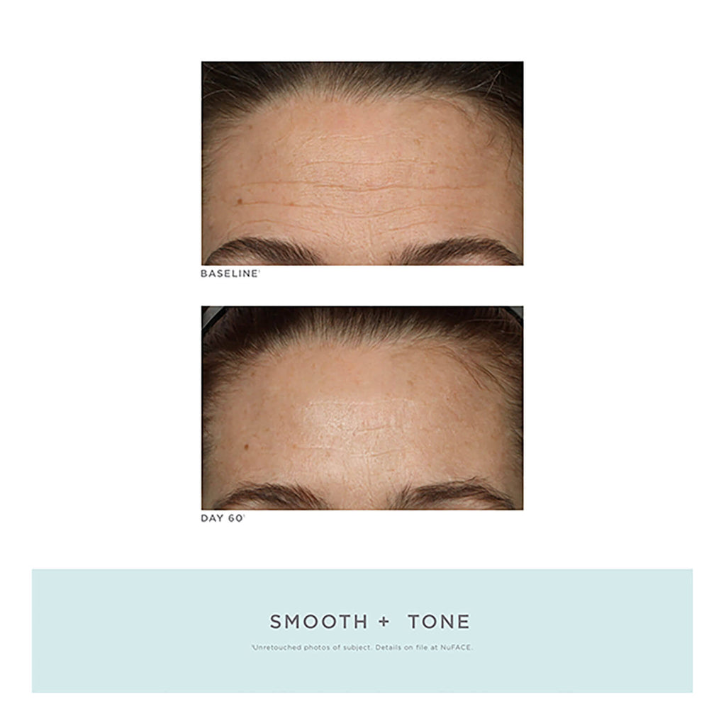 Trinity Facial Toning Device + Wrinkle Reducer Attachment Bundle C296661
