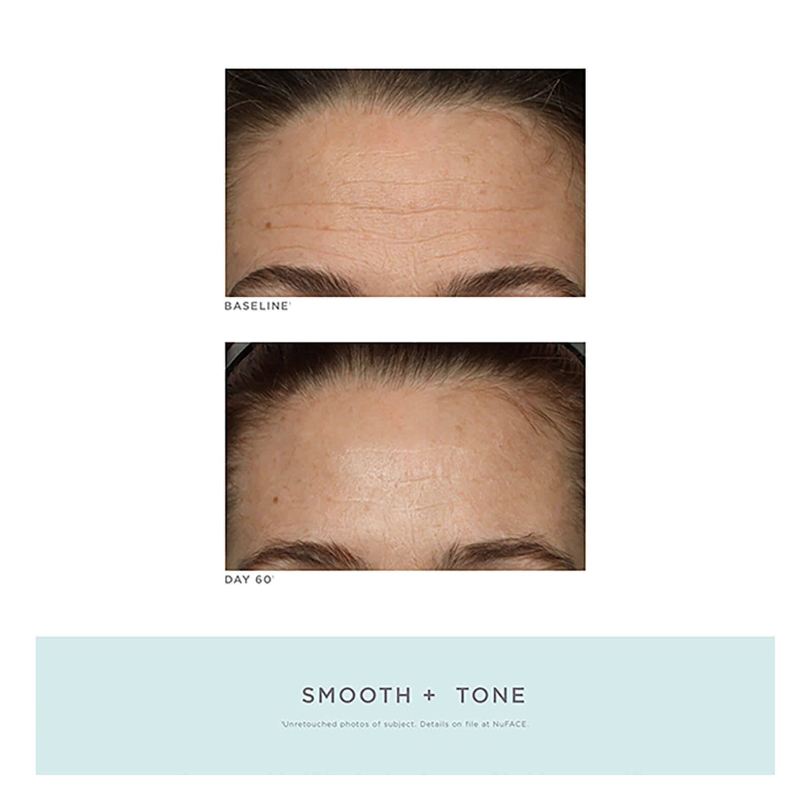 Trinity Facial Toning Device + Wrinkle Reducer Attachment Bundle C296661