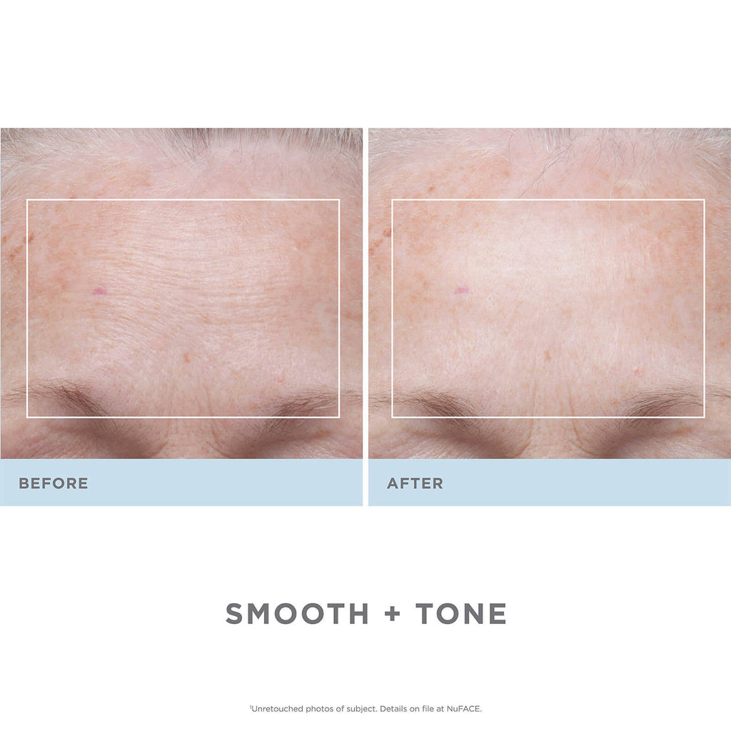 Trinity Facial Toning Device + Wrinkle Reducer Attachment Bundle C296661